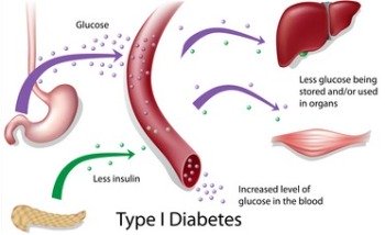 feline diabetes type 1